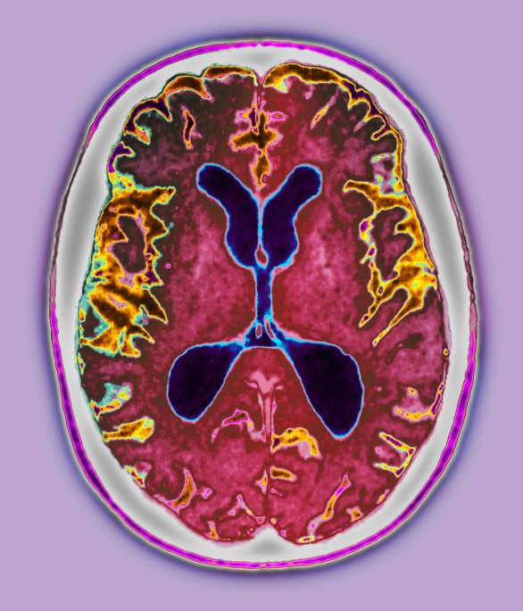 Alzheimer's disease: mapping the brain's decline