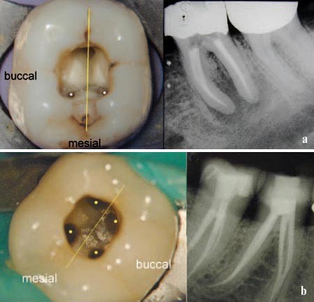 A practical guide to endodontic access cavity preparation in molar teeth |  British Dental Journal