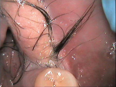 Intraoral hair removal on skin graft using nd:yag laser