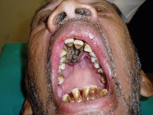 Larvae in the mouth | British Dental Journal