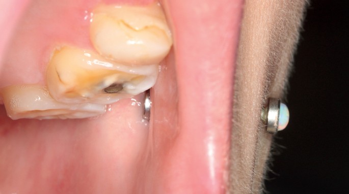 A guide to oral piercings | BDJ Team