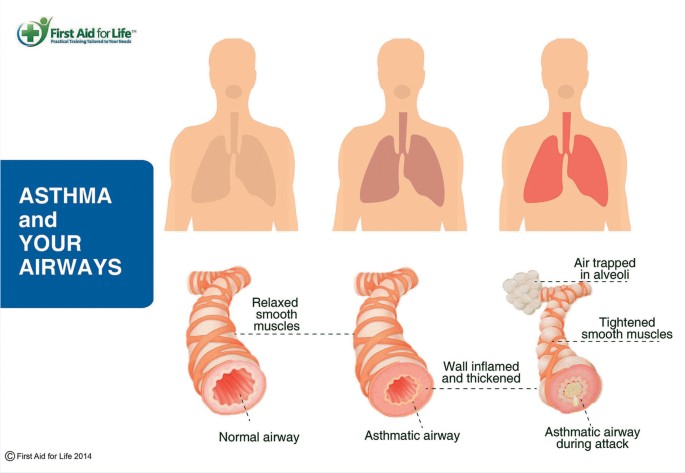 Medical emergencies: asthma | BDJ Team