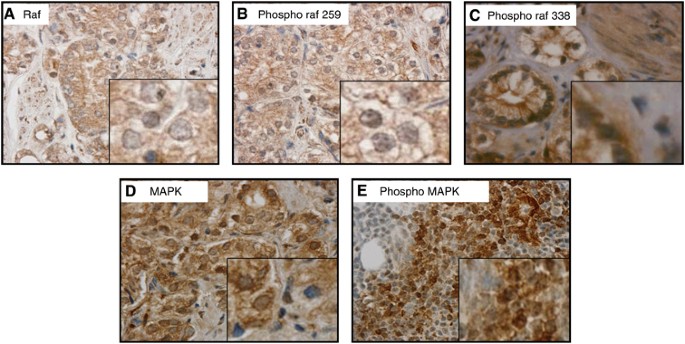 Upregulation of mapk pathway is associated with survival in castrate-resistant prostate cancer