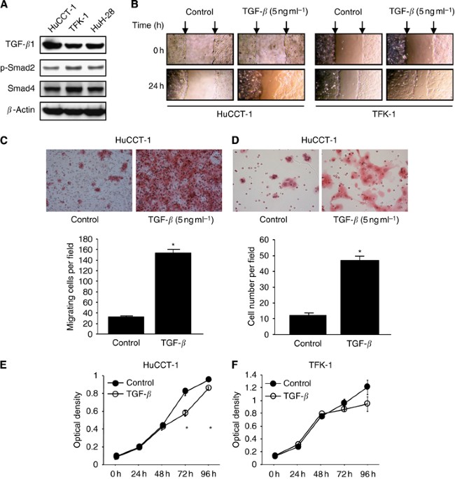 E/N-cadherin switch mediates cancer progression via TGF-β-induced  epithelial-to-mesenchymal transition in extrahepatic cholangiocarcinoma |  British Journal of Cancer