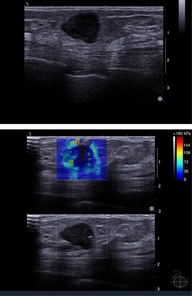 Differentiating benign from malignant solid breast masses: value