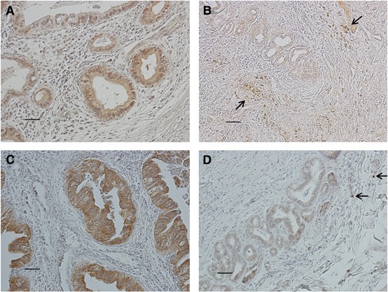Concurrent analysis of human equilibrative nucleoside transporter 1 and ribonucleotide reductase subunit 1 expression increases predictive value for p