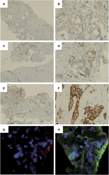 PDF) ACTN4 gene amplification is a predictive biomarker for