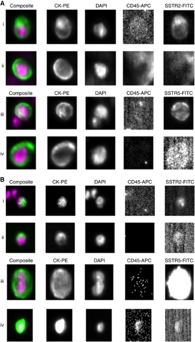 Expression of somatostatin receptors 2 and 5 in circulating tumour cells  from patients with neuroendocrine tumours | British Journal of Cancer