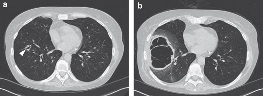 Black Hole In The Lung Bone Marrow Transplantation