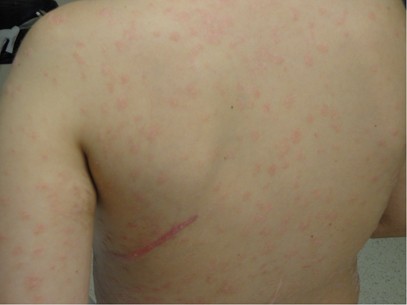 guttate psoriasis scar treatment