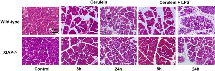 Deletion Of Xiap Reduces The Severity Of Acute Pancreatitis Via Regulation Of Cell Death And Nuclear Factor Kb Activity Cell Death Disease Deletion Of Xiap Reduces The Severity Of Acute Pancreatitis Via Regulation Of Cell Death And Nuclear Factor Kb Activity Cell Death Disease