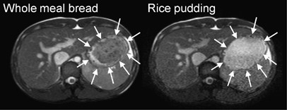 Delayed gastric emptying and reduced postprandial small bowel water content of equicaloric whole meal bread versus rice meals in healthy subjects: novel mri insights
