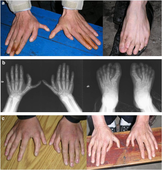 PDF) An unusual presentation of Rubinstein-Taybi Syndrome with bilateral  postaxial polydactyly Corresponding author