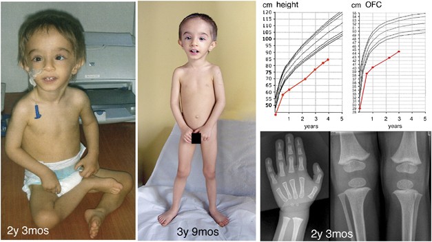 Refinement Of The 12q14 Microdeletion Syndrome Primordial Dwarfism And Developmental Delay With Or Without Osteopoikilosis European Journal Of Human Genetics