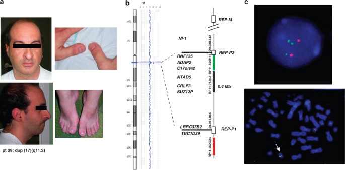 A novel CREBBP mutation and its phenotype in a case of Rubinstein–Taybi  syndrome, BMC Medical Genomics