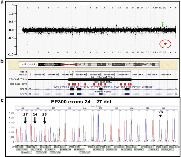 Clinical exome sequencing identifies novel CREBBP variants in 18 Chinese  Rubinstein–Taybi Syndrome kids with high frequency of polydactyly - Yu -  2019 - Molecular Genetics & Genomic Medicine - Wiley Online Library