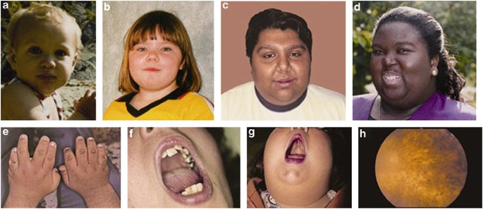 Bardet–Biedl syndrome | European Journal of Human Genetics