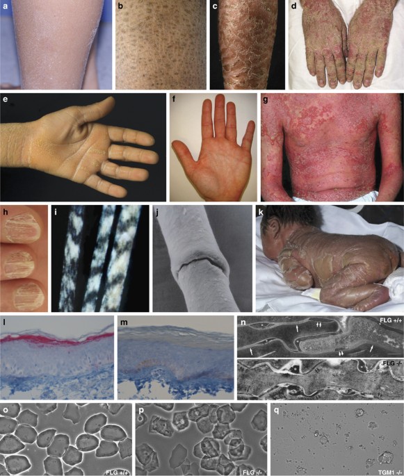 Inherited Ichthyoses Generalized Mendelian Disorders Of Cornification European Journal Of Human Genetics