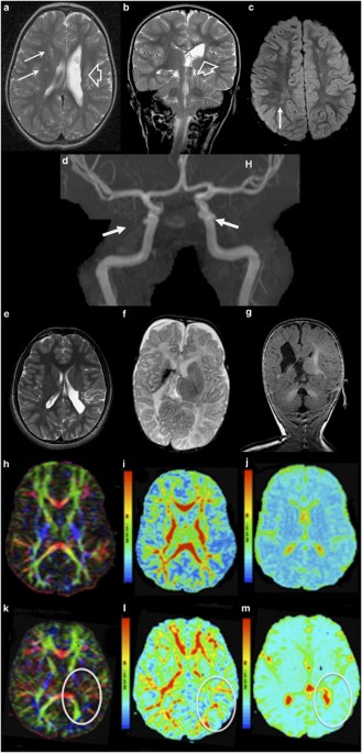 (PDF) Identification of de novo EP300 and PLAU variants in a patient with  Rubinstein–Taybi syndrome-related arterial vasculopathy and skeletal anomaly