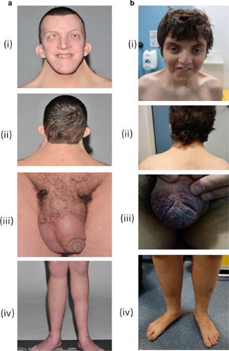 The lymphatic phenotype in Noonan and Cardiofaciocutaneous