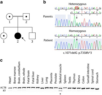 A new early-onset neuromuscular disorder associated with kyphoscoliosis peptidase ( KY ) deficiency