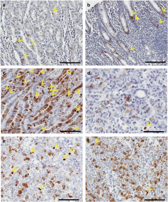 Clinical implications of proliferation activity in T1 or T2 male gastric cancer patients