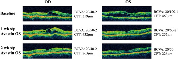 Bilateral Improvement Of Persistent Diffuse Diabetic Macular Oedema After Unilateral Intravitreal Bevacizumab Avastin Injection Eye