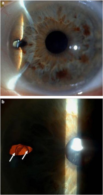 Monocular diplopia induced by posterior chamber intraocular lens in a  patient with peripheral laser iridotomy: a case report | Eye