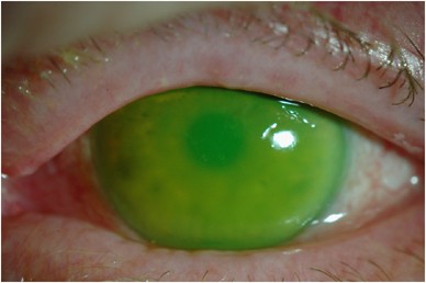 Inadvertent Administration Of Olbas Oil Into The Eye A Surprisingly Frequent Presentation Eye