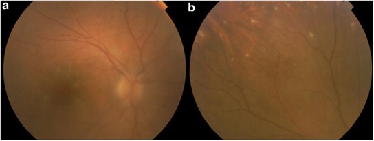 White dots in the eye fundus revealing Hodgkin's lymphoma | Eye White dots in the eye fundus revealing Hodgkin's lymphoma | Eye