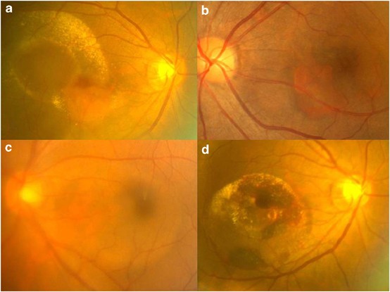 Polypoidal choroidal vasculopathy: an angiographic discussion | Eye