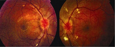 Acute Angle Closure Glaucoma As The Presenting Sign Of Hypertensive Crisis Eye