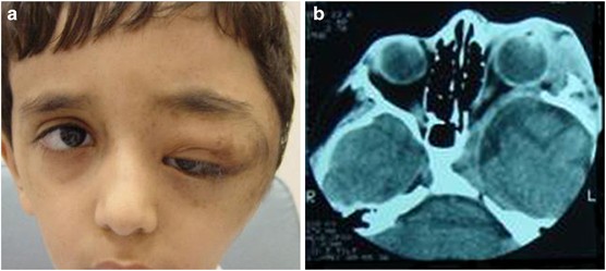 Orbitofacial Neurofibromatosis Clinical Characteristics And Treatment Outcome Eye