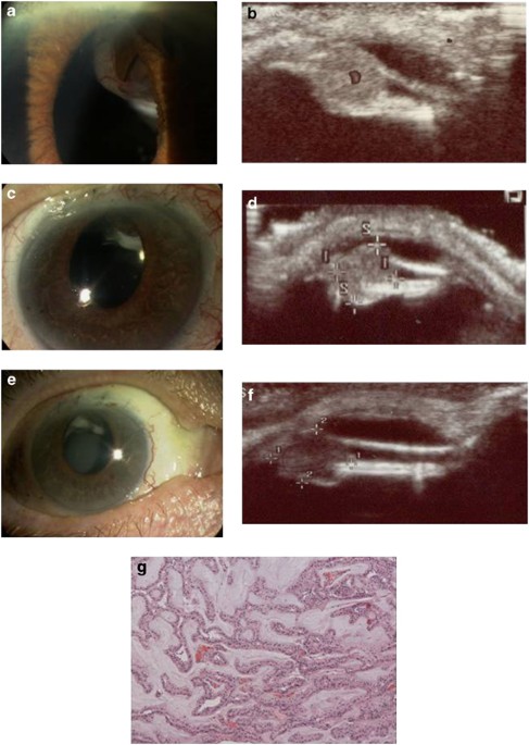 Ciliary-body adenoma of the non-pigmented epithelium with rubeosis iridis treated with plaque brachytherapy and bevacizumab