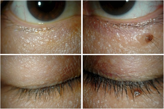 Adverse periocular reactions to five types of prostaglandin analogs | Eye Adverse periocular reactions to five types of prostaglandin analogs | Eye