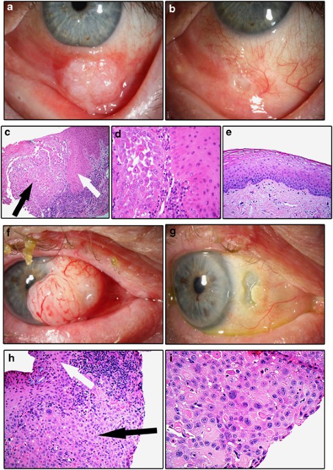 Treatment of invasive ocular surface squamous neoplasia with proton beam therapy