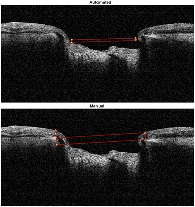 The comparison of manual vs automated disc margin delineation using spectral-domain optical coherence tomography
