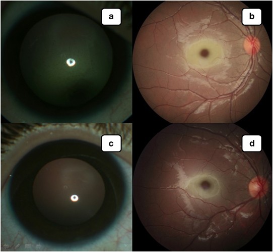 Cherry-Red Spot in Tay–Sachs Disease