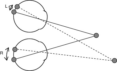 Stereo Vision And Strabismus Eye Stereo Vision And Strabismus Eye