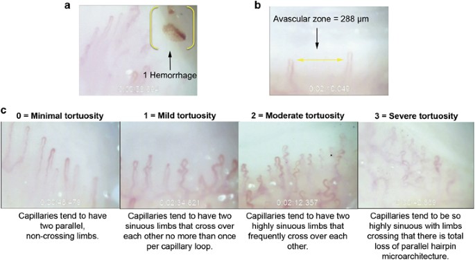 The Established and Evolving Role of Nailfold Capillaroscopy in  Connective-Tissue Disease | IntechOpen
