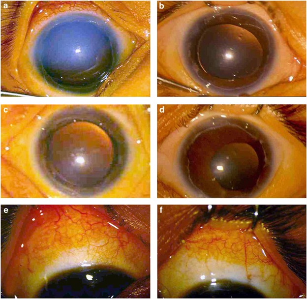Early-onset glaucoma in Axenfeld–Rieger anomaly: long-term surgical results and visual outcome