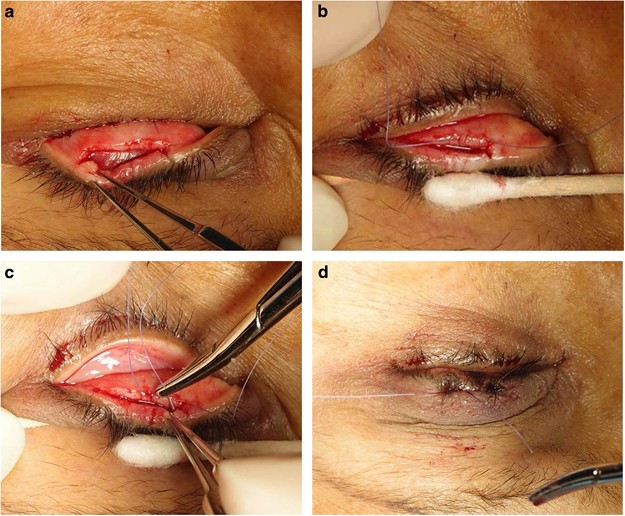 Modified tarsotomy for the treatment of severe cicatricial entropion