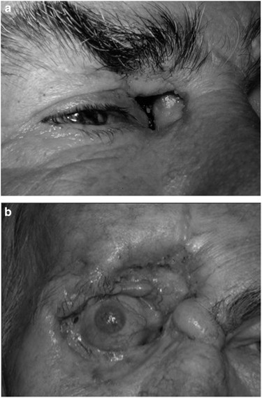 Black Eye (periorbital haematoma): Causes, Symptoms, Risk Factor