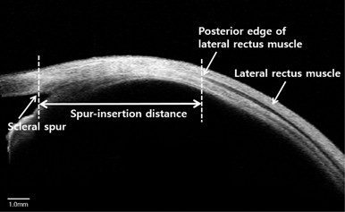 Postoperative change in lateral rectus muscle insertion measured by anterior segment optical coherence tomography | Eye Postoperative change in lateral rectus muscle insertion measured by anterior segment optical coherence tomography | Eye