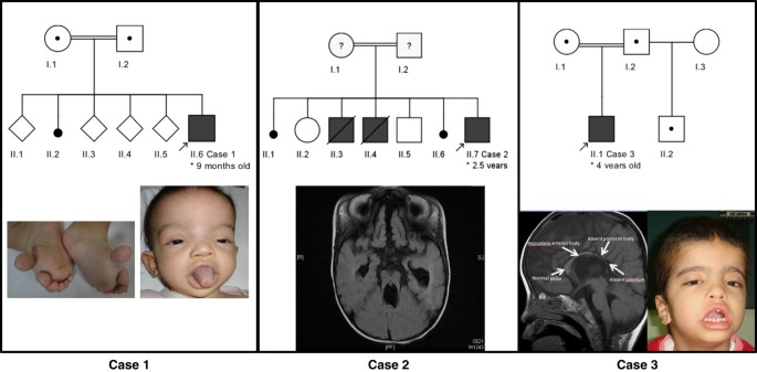 Clinical photos of the patients. (a) Case 1: Dysmorphic facial