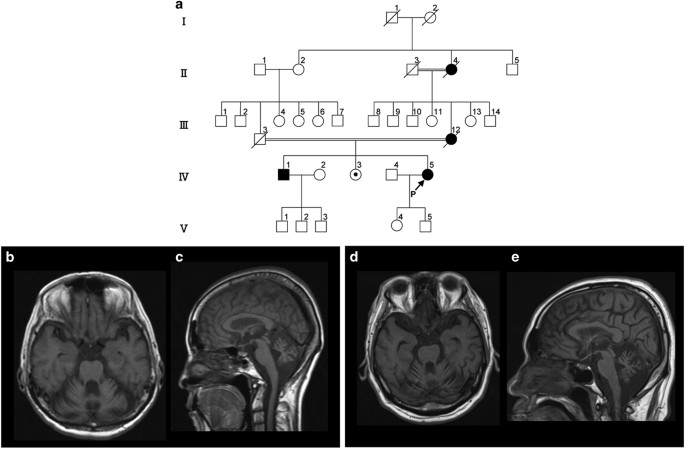 A Novel Frameshift Mutation Of Syne1 In A Japanese Family With Autosomal Recessive Cerebellar Ataxia Type 8 Human Genome Variation A Novel Frameshift Mutation Of Syne1 In A Japanese Family With Autosomal Recessive Cerebellar Ataxia Type 8 Human Genome Variation