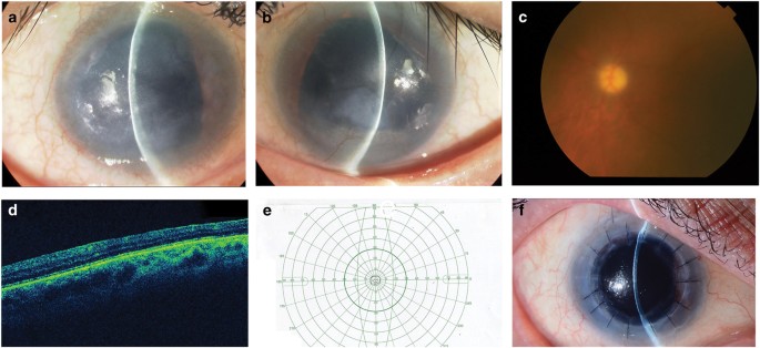 Novel pax6 mutation reported in an aniridia patient