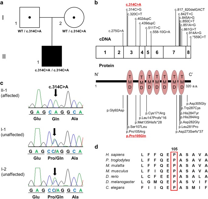 A Novel Pgap3 Mutation In A Croatian Boy With Brachytelephalangy And A Thin Corpus Callosum Human Genome Variation