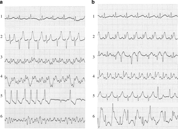 Effects Of Metoprolol On Epinephrine Induced Takotsubo Like Left Ventricular Dysfunction In Non Human Primates Hypertension Research