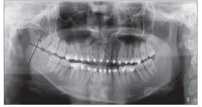 Correction of mandibular deficiency by inverted-L osteotomy of ramus and  iliac crest bone grafting | International Journal of Oral Science